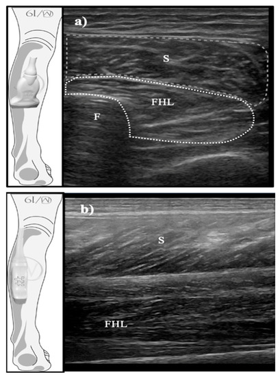 Medicina Free Full-Text Does Function Determine the Structure? Changes in Flexor Hallucis Longus Muscle and the Associated Performance Related to Dance Modality A Cross-Sectional Study