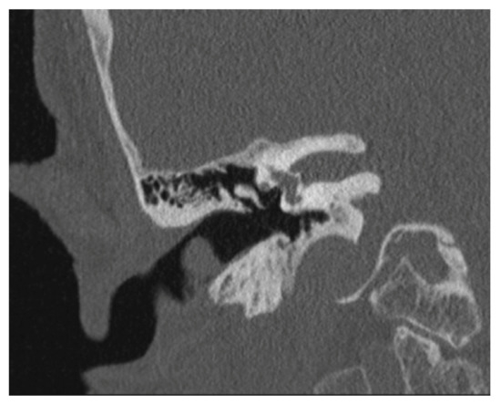 Medicina | Free Full-Text | Pleomorphic Adenoma of External Auditory ...