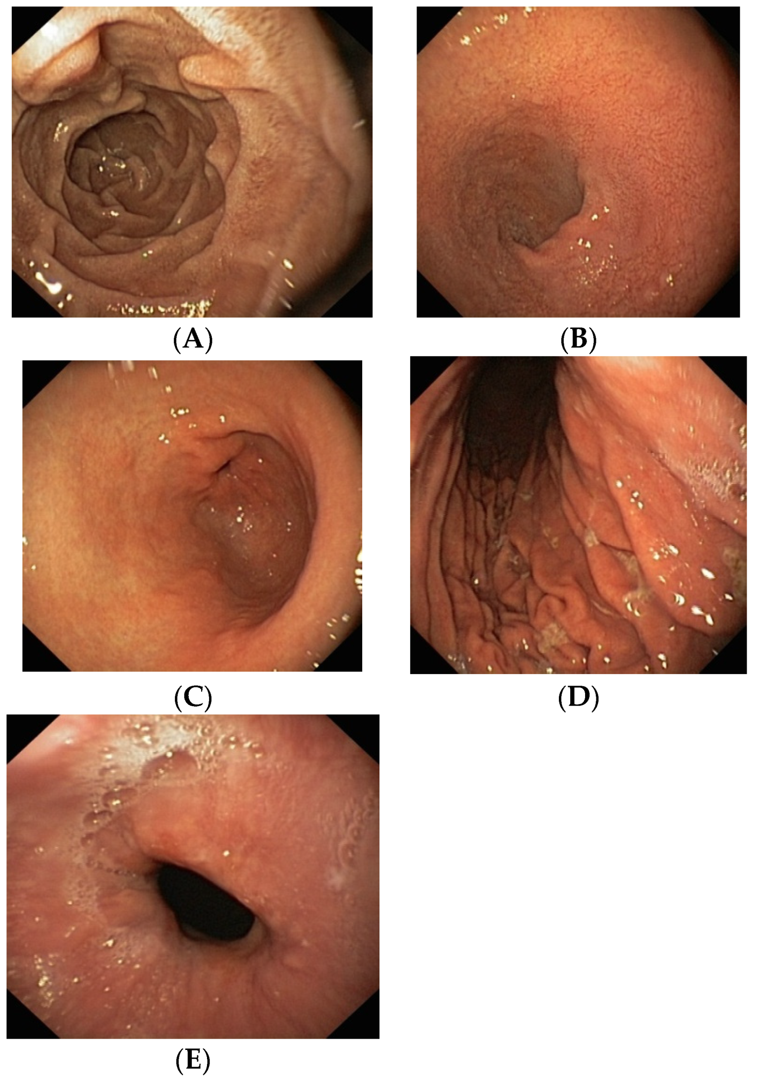 Medicina | Free The Impact of Novel Anticoagulants on the Upper Gastrointestinal Tract Mucosa | HTML