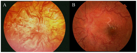 Medicina | Free Full-Text | The Natural History of Retinal Vascular Changes  from Infancy to Adulthood in Wyburn-Mason Syndrome | HTML