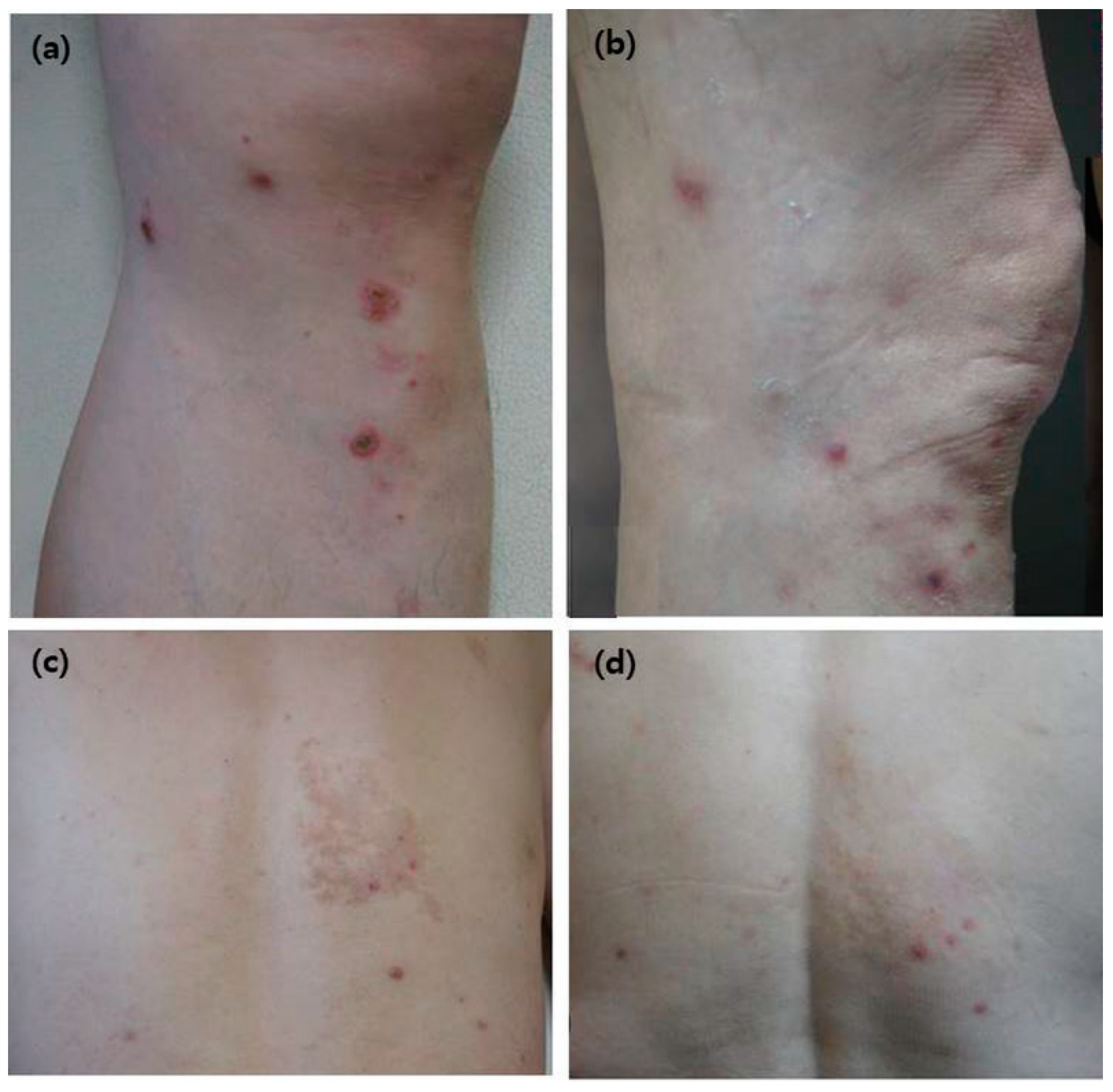 Clinical picture of Case 2 showing an erythematous scaly skin rash
