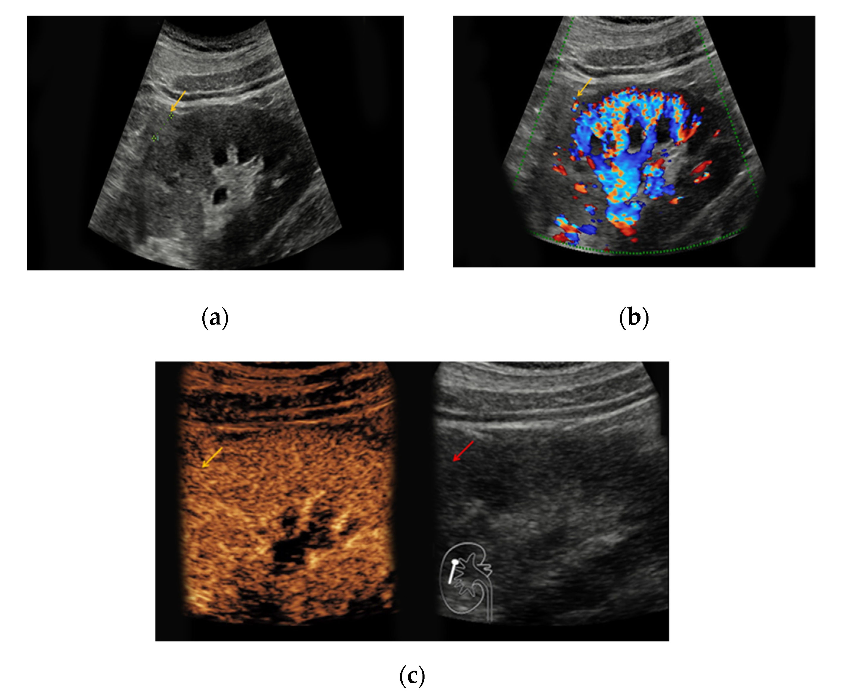 pyelonephritis ultrasound doppler