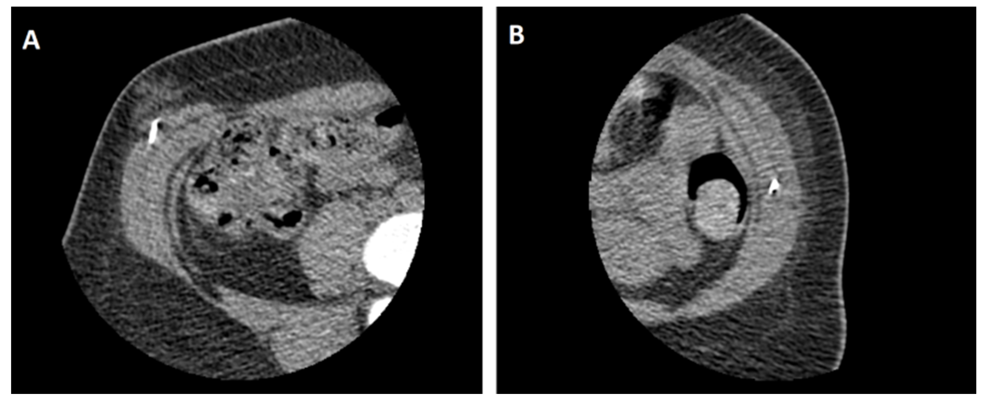 Medicina Free Full Text Low Dose Pre Operative Botulinum Toxin A Effectively Facilitates 9098