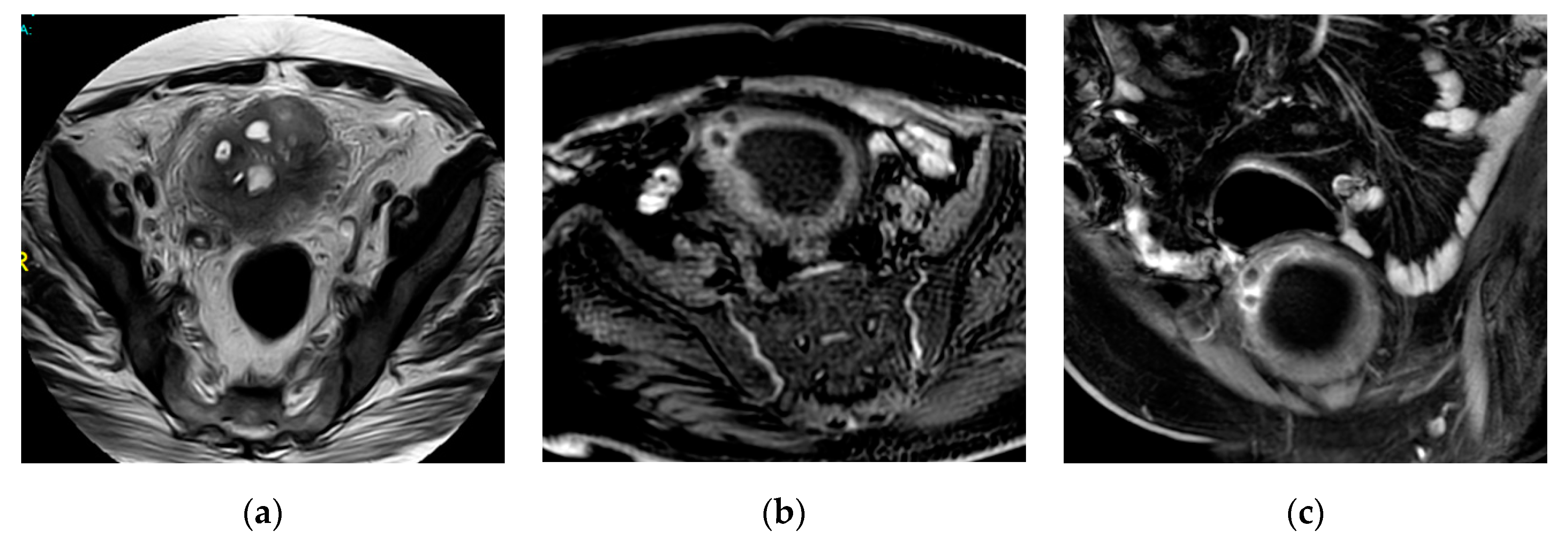 Medicina Free Full Text Ct And Mri In Urinary Tract Infections A