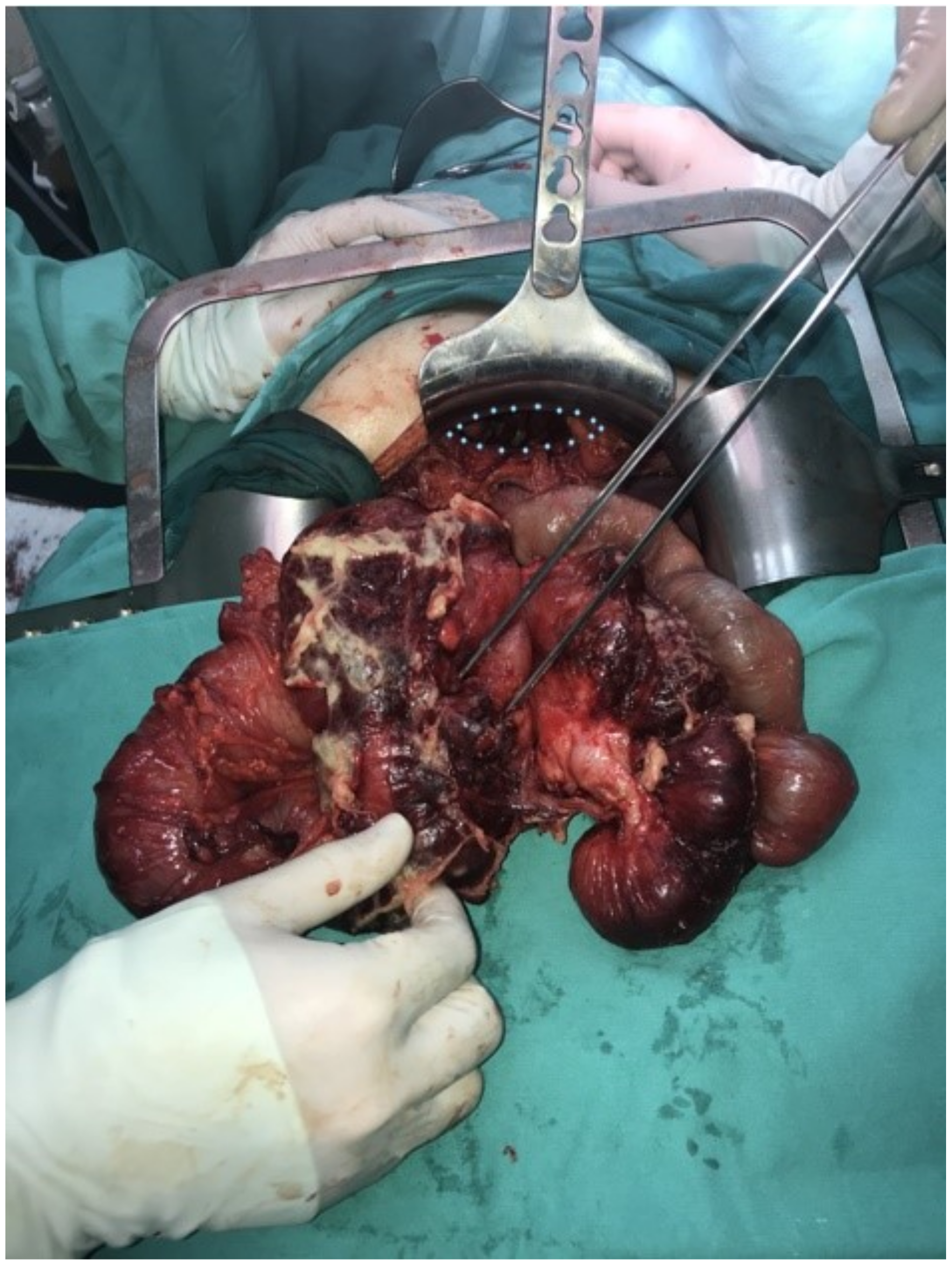 Medicina | Free Full-Text | Perforated Appendicitis and Bowel Incarceration  within Morgagni Hernia: A Case Report