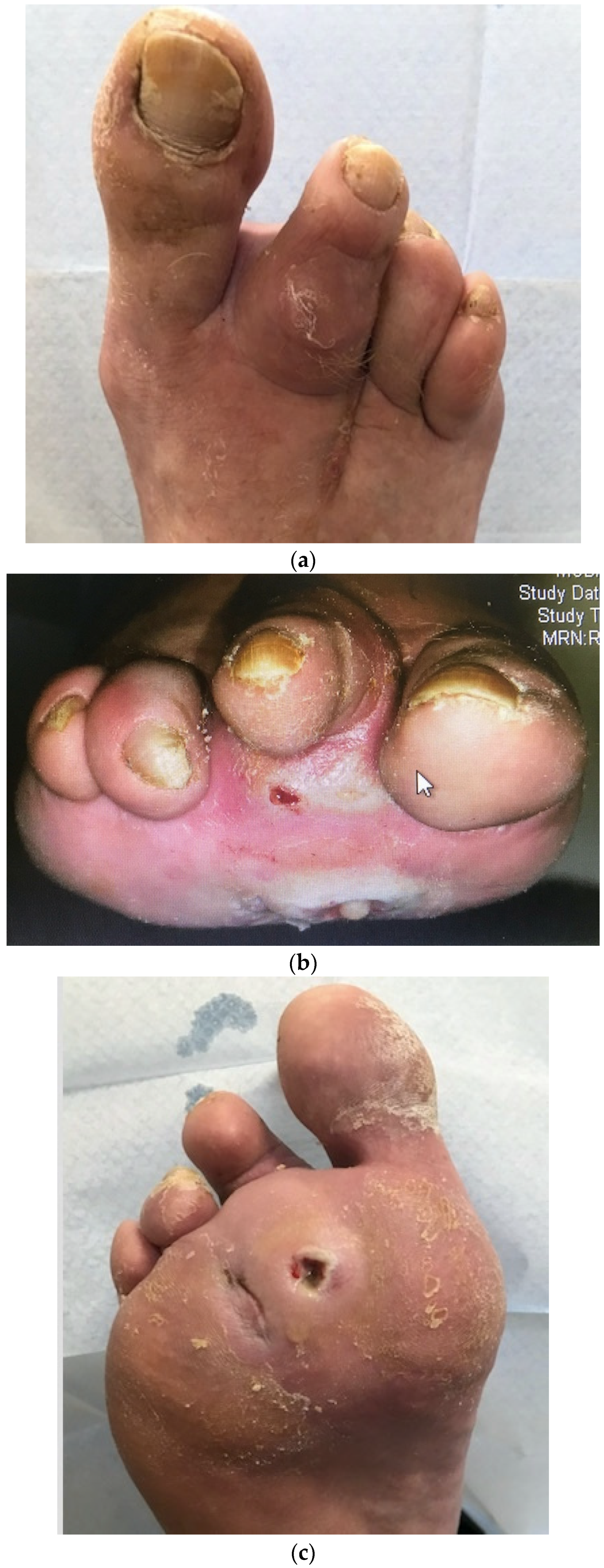 Medicina | Free Full-Text | Diabetic Foot Disease during the COVID-19  Pandemic