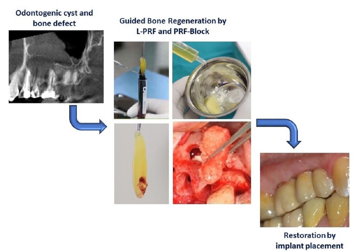 Medicina | Free Full-Text | Leucocyte- and Platelet-Rich Fibrin Block: Its  Use for the Treatment of a Large Cyst with Implant-Based Rehabilitation