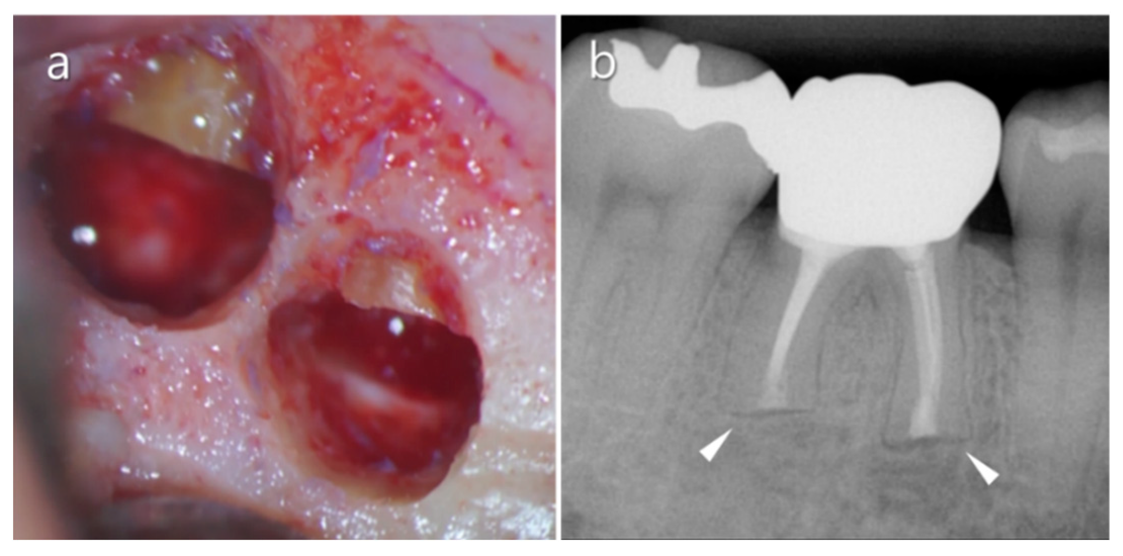 Medicina | Free Full-Text | An Update On Endodontic Microsurgery Of ...