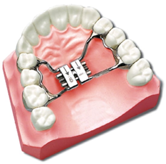 Rapid Palatal Expander (Palate Expander) - Yang Orthodontics
