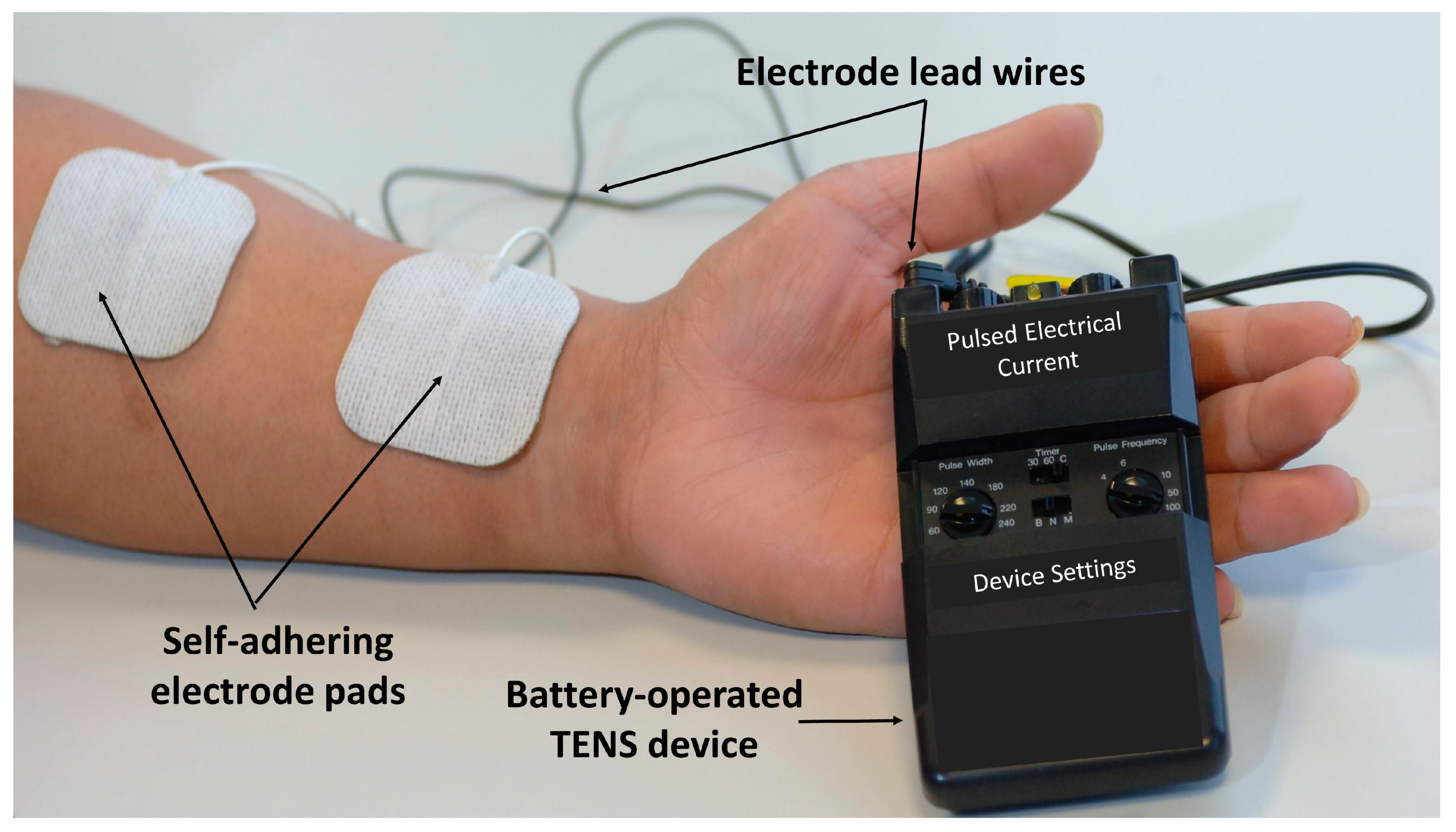 Medicina | Free Full-Text | Resolving Long-Standing Uncertainty about the  Clinical Efficacy of Transcutaneous Electrical Nerve Stimulation (TENS) to  Relieve Pain: A Comprehensive Review of Factors Influencing Outcome