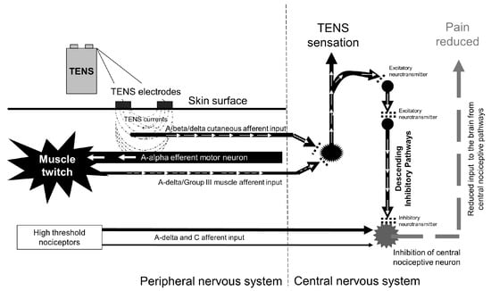 TENS Unit Placement 101: Insights into Effective Electrode Positioning