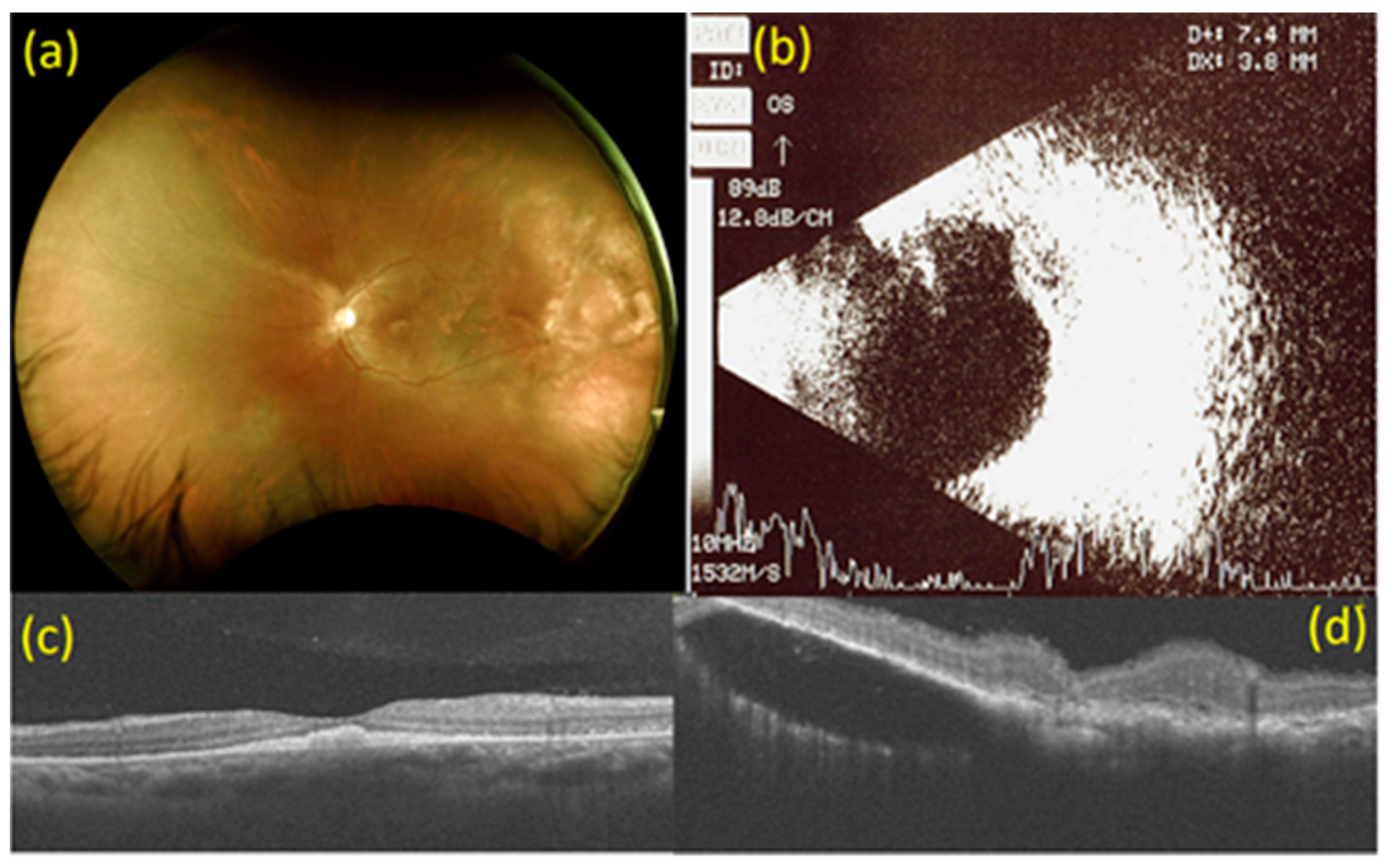 Medicina Free Full Text Adjuvant Intravitreal Bevacizumab Injection For Choroidal And Orbital Metastases Of Refractory Invasive Ductal Carcinoma Of The Breast Html