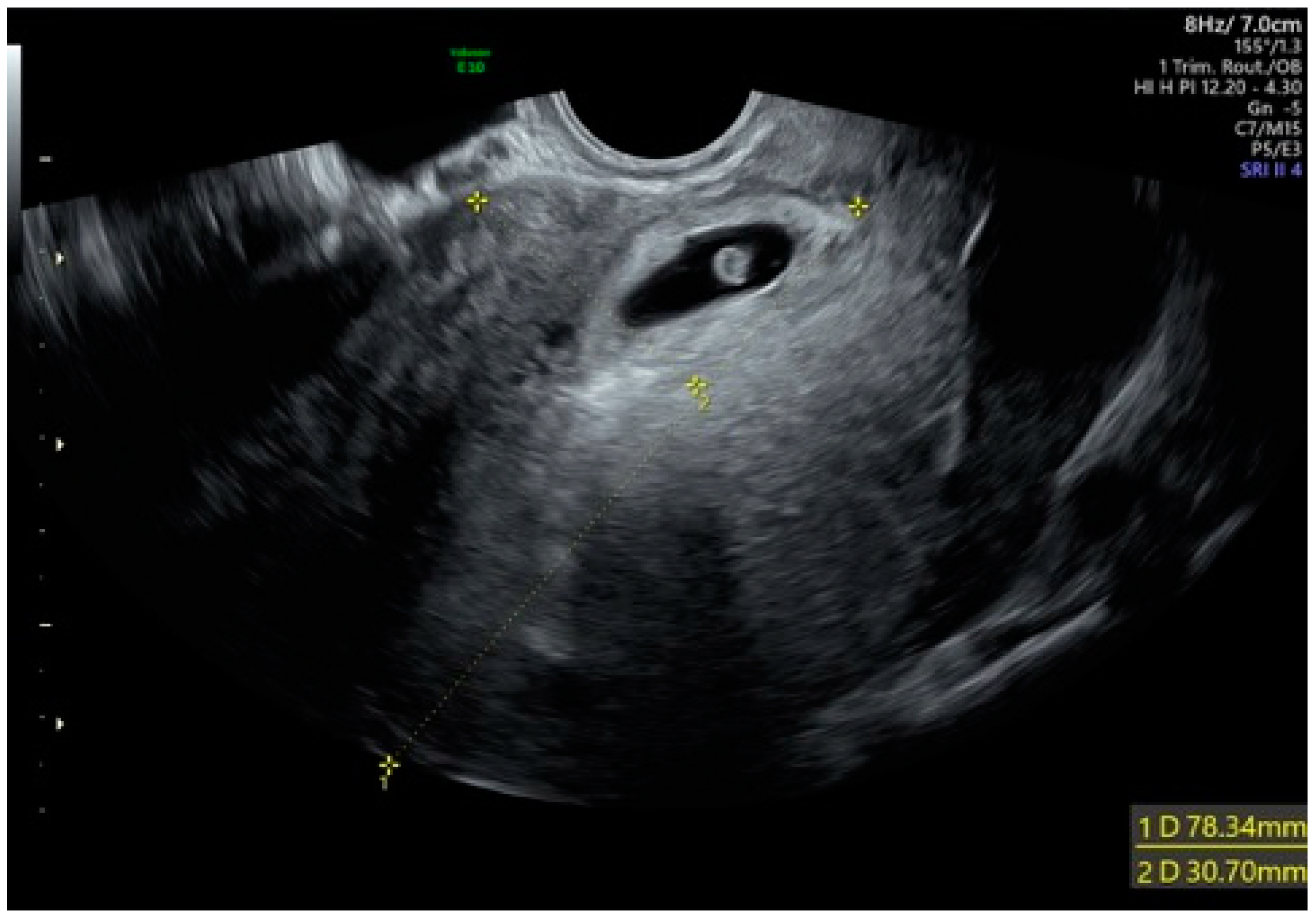 Medicina | Free Full-Text | Cesarean Scar Pregnancy Treated by Artery  Embolization Combined with Diode Laser: A Novel Approach for a Rare Disease
