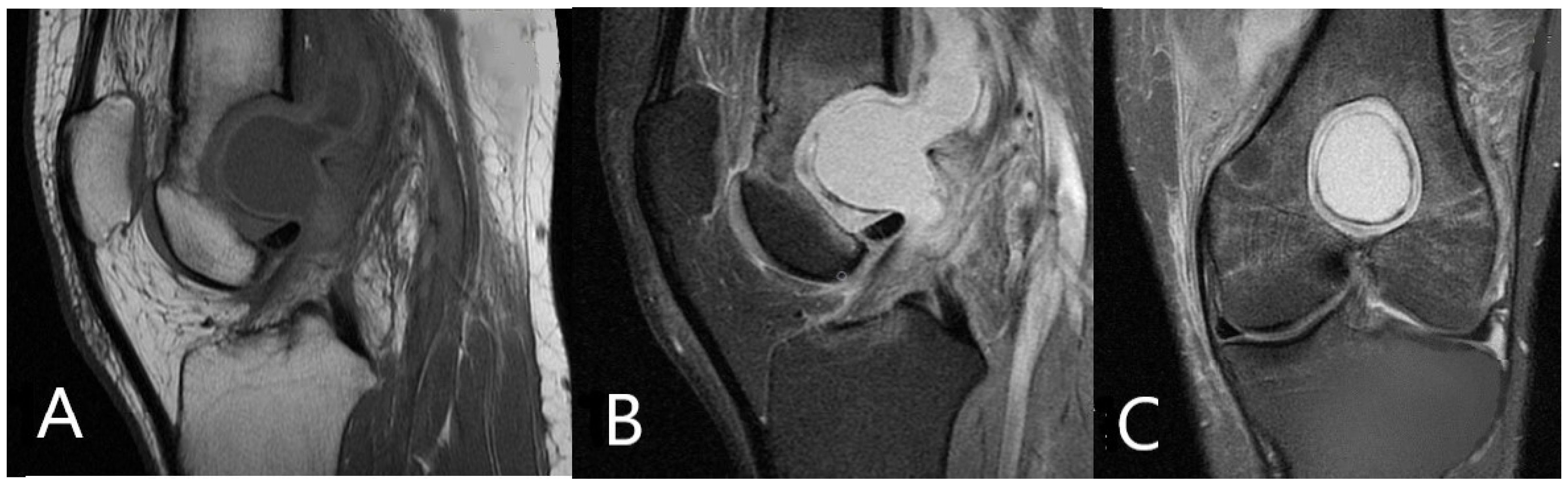 Medicina Free Full Text Rare Intercondylar Distal Femoral