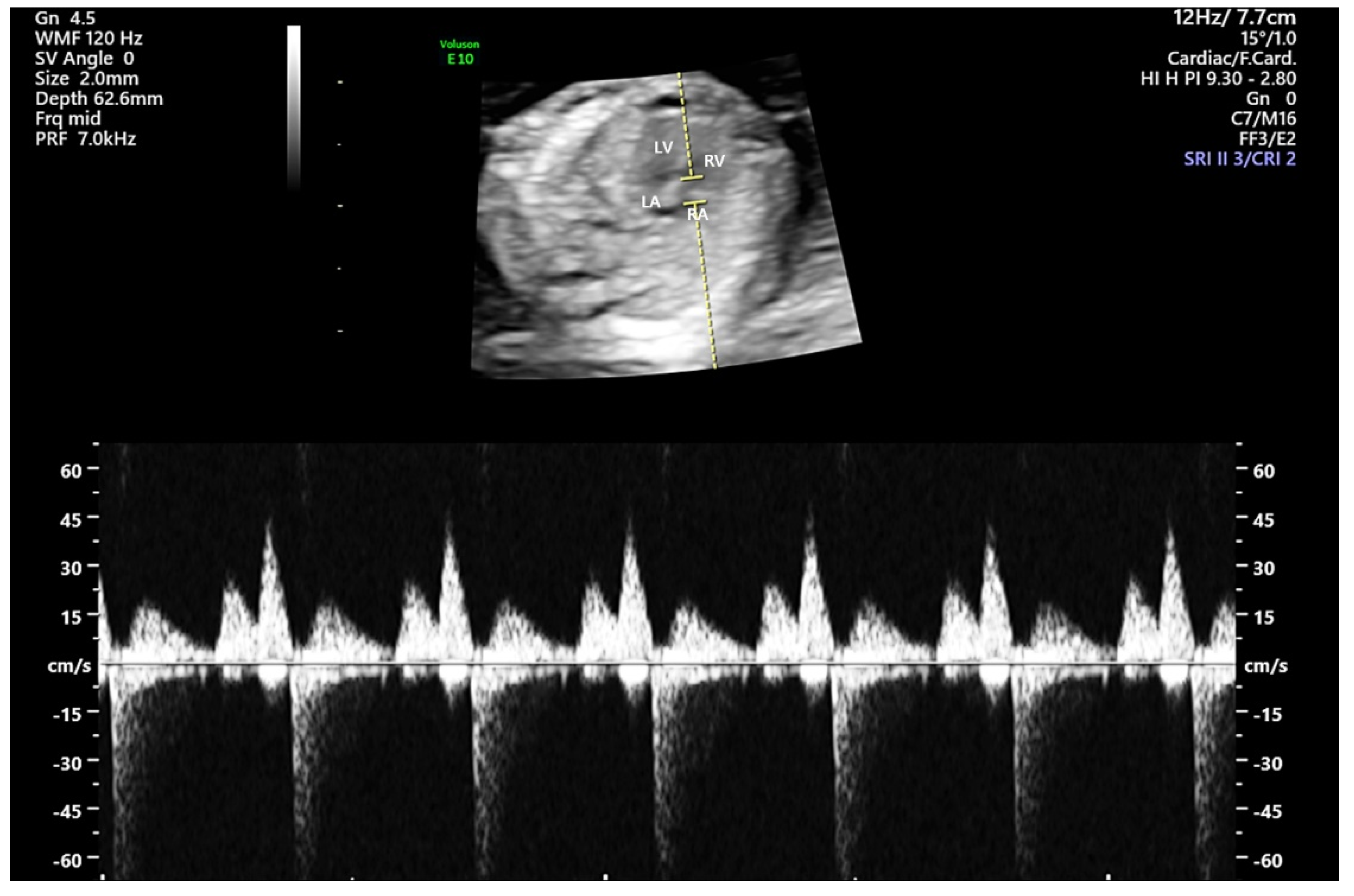 medicina-free-full-text-mild-fetal-tricuspid-regurgitation-in-the