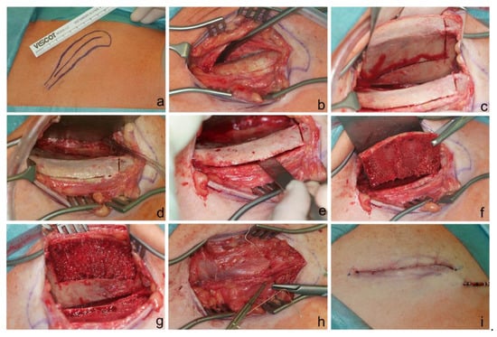 Manubrial Resection and Reconstruction With Iliac Wing Bone Autograft -  ScienceDirect