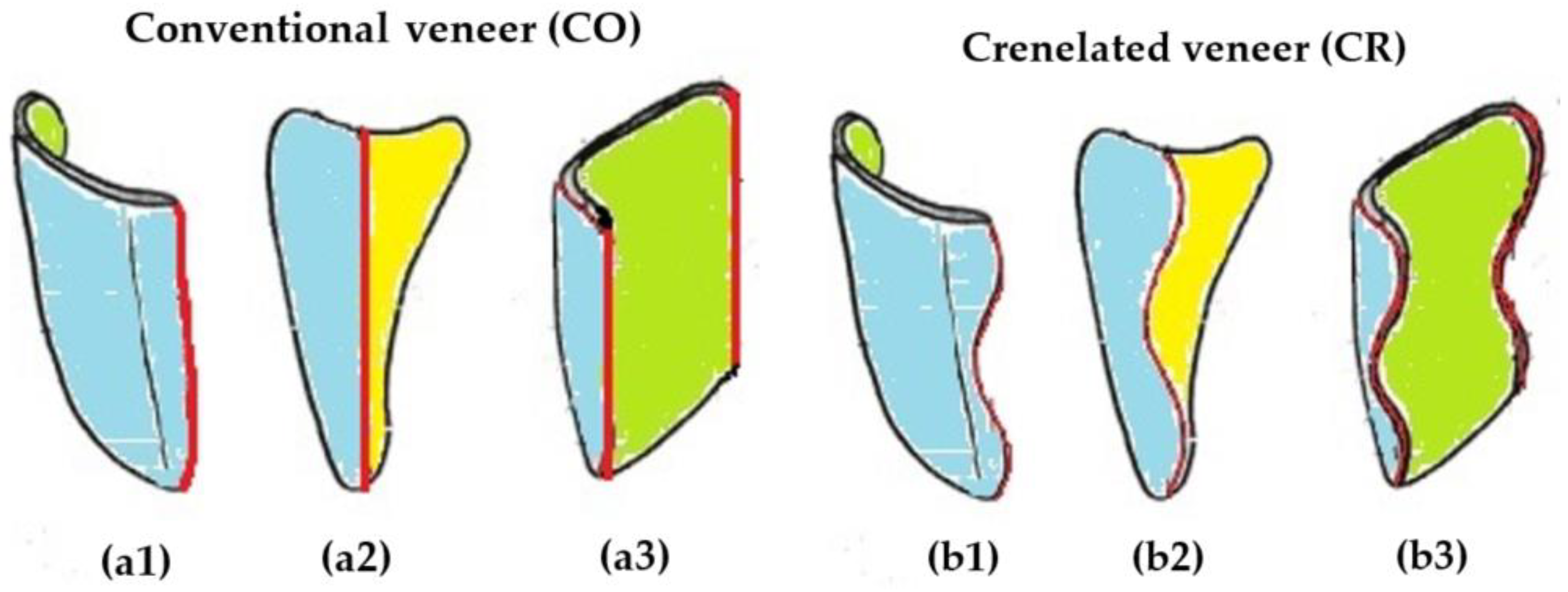 Medicina Free Full Text Micro Ct And Microscopy Study Of Internal And Marginal Gap To Tooth Surface Of Crenelated Versus Conventional Dental Indirect Veneers Html