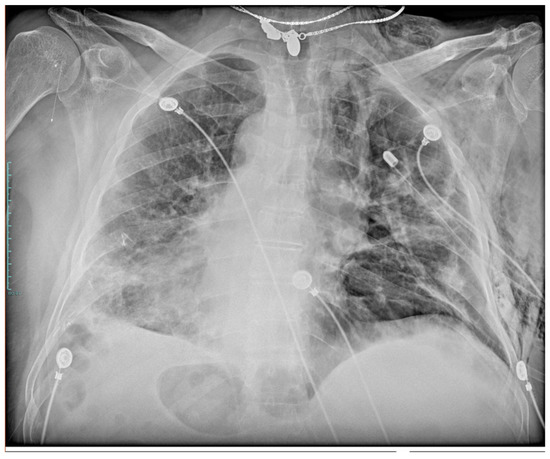 Medicina Free Full Text Pneumomediastinum And Pneumothorax As