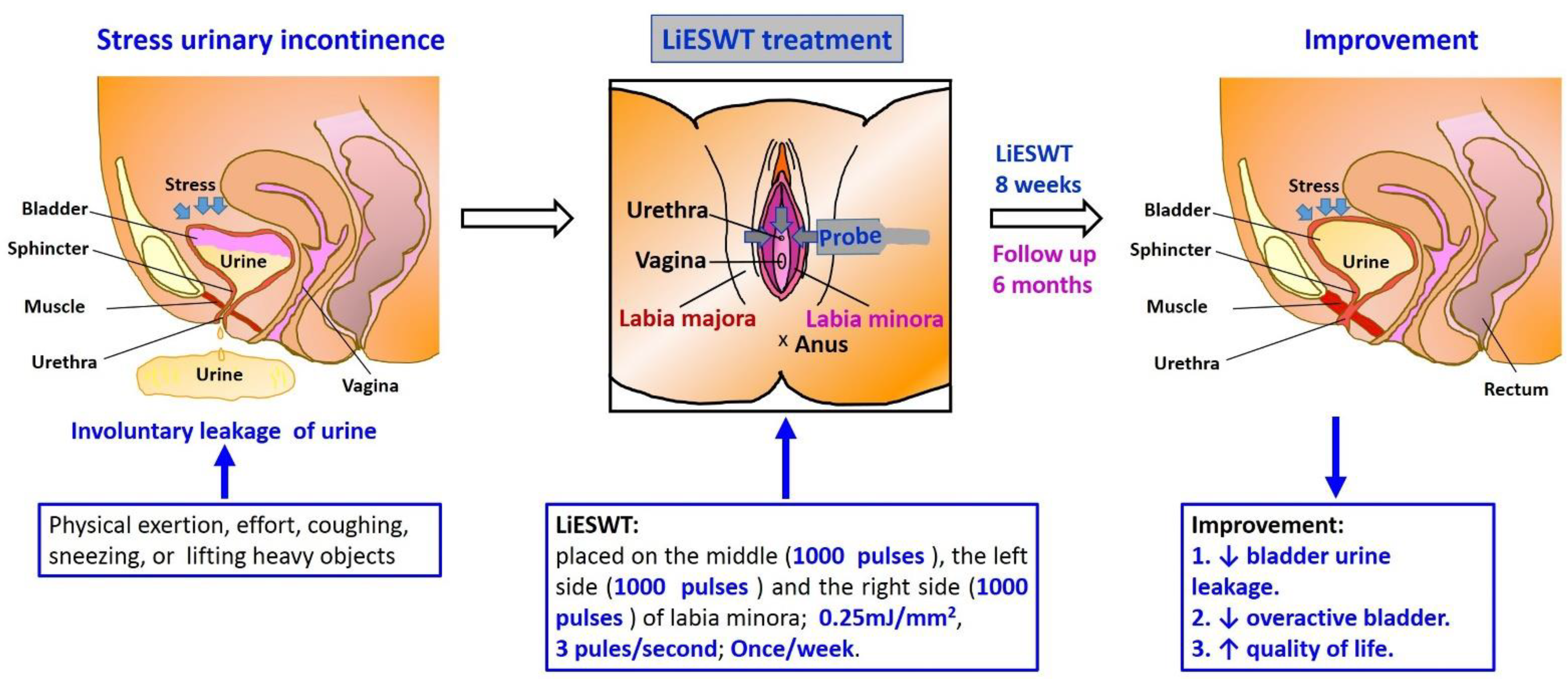 Extracorporeal Shock Wave Therapy Combined With Oral Medication and  Exercise for Chronic Low Back Pain: A Randomized Controlled Trial -  ScienceDirect