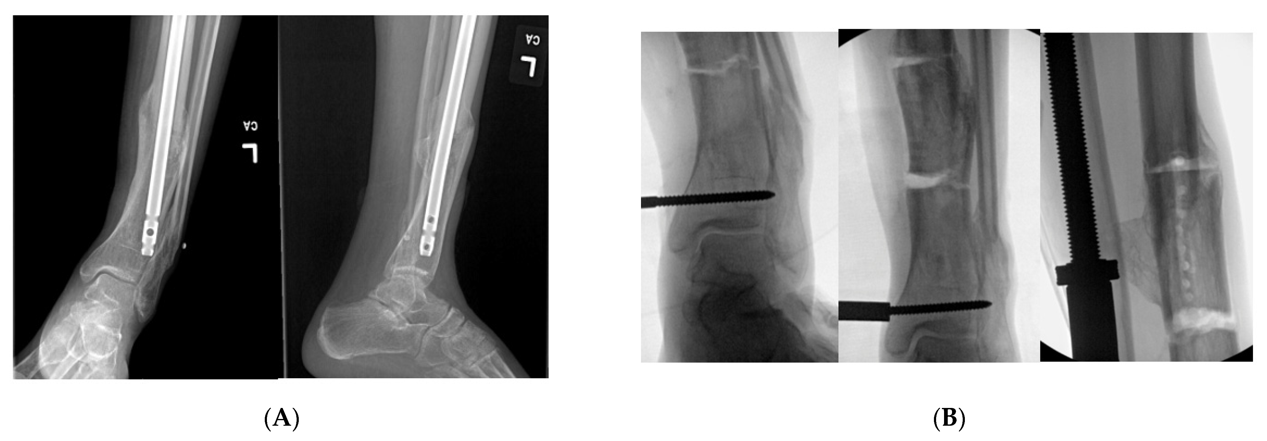 Open Tibia Fracture