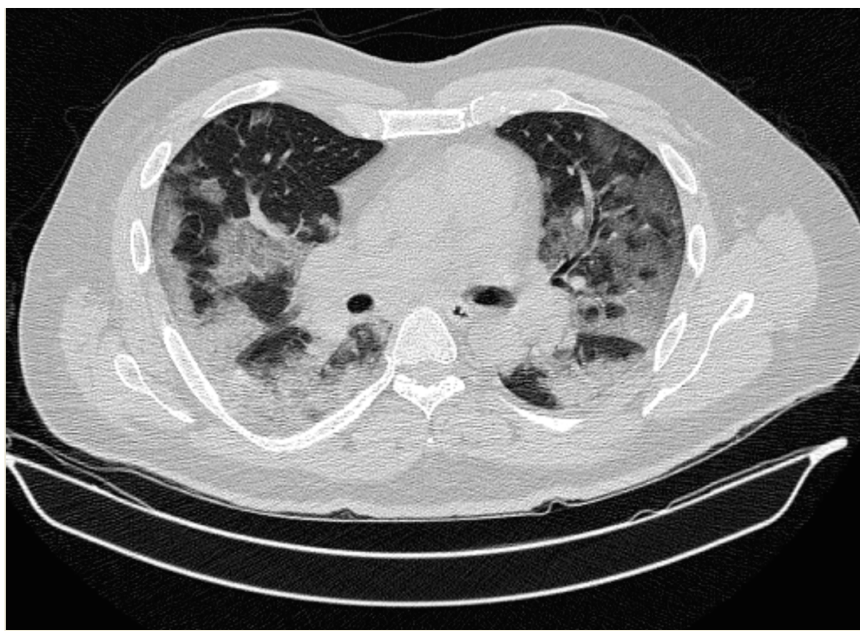 Medicina | Free Full-Text | Diagnosing a Patient with Erdheim 