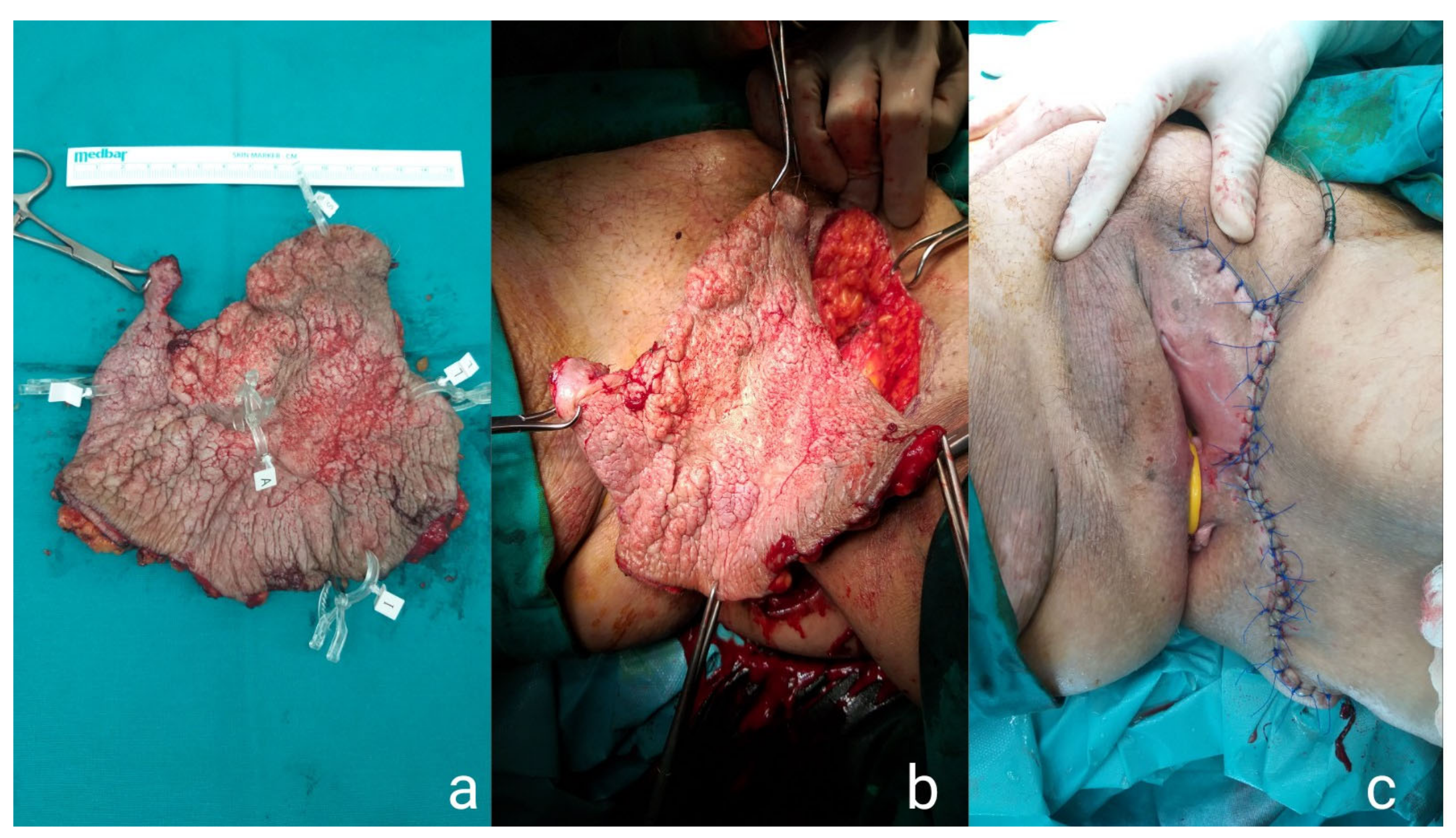 Diseases of vulva