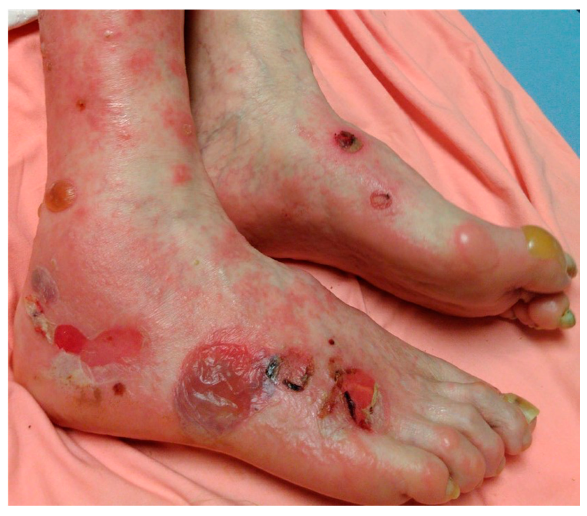 Bullous pemphigoid blisters - Stock Image - C055/9327 - Science Photo  Library