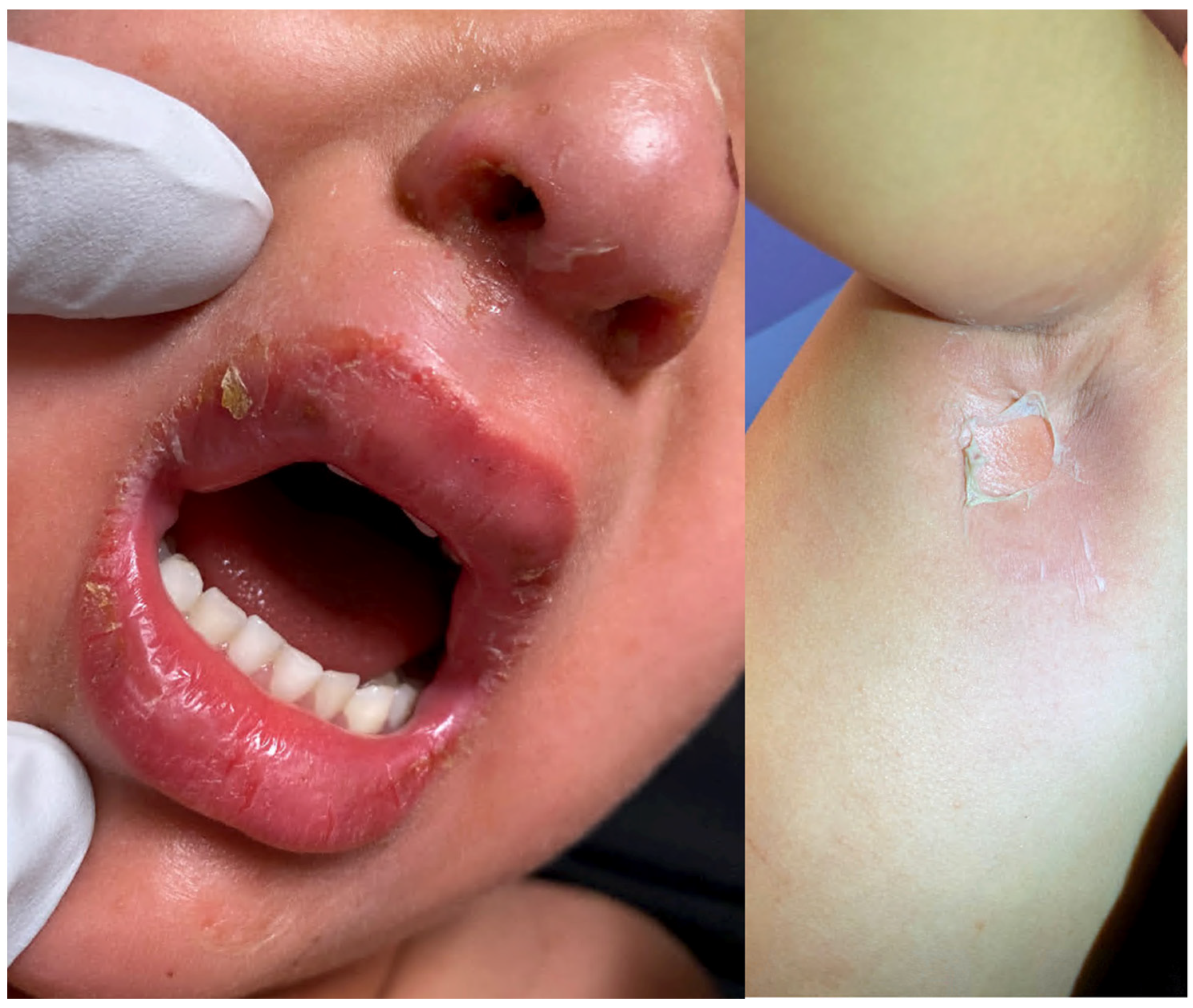 Medicina | Free Full-Text | Staphylococcal Scalded Skin Syndrome and  Bullous Impetigo | HTML