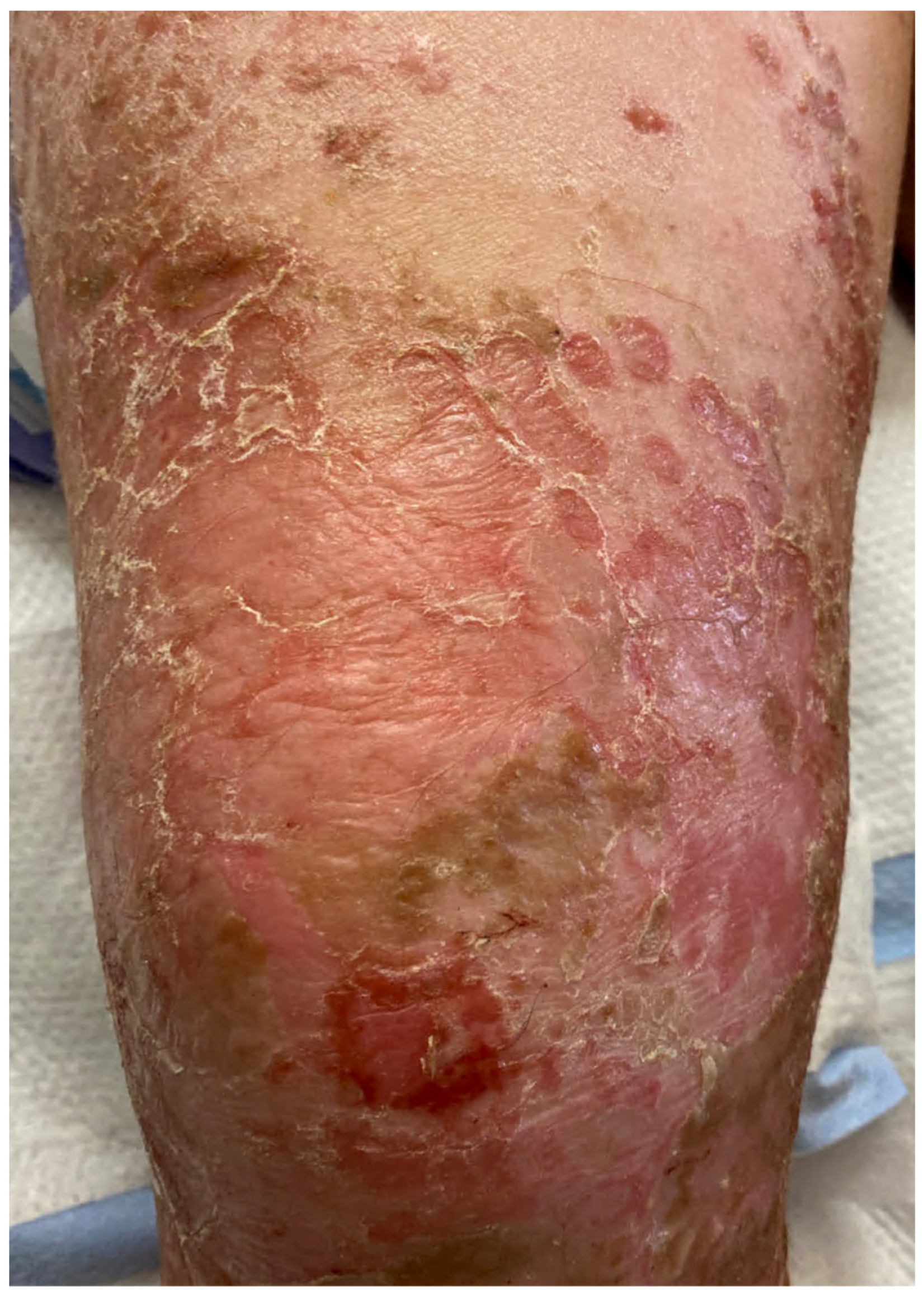 Staphylococcal scaldeWd skin syndrome and toxic shock syndrome.