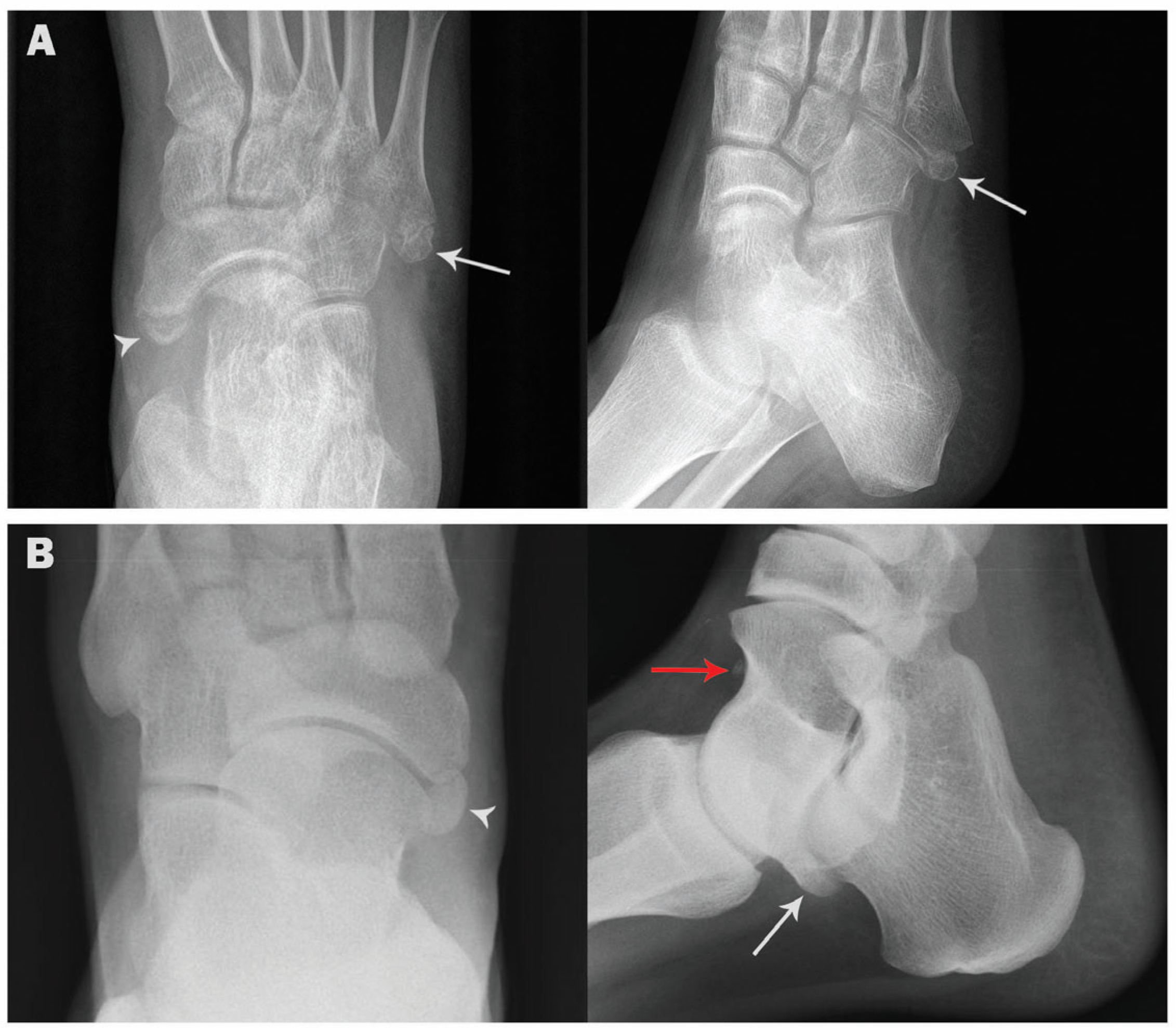 Medicina | Free Full-Text | Accessory Ossicles in the Region of the Foot  and Ankle: An Epidemiologic Survey in a Jordanian Population
