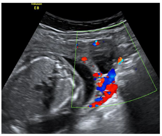 A unique case of diagnosis of a heterotopic pregnancy at 26 weeks