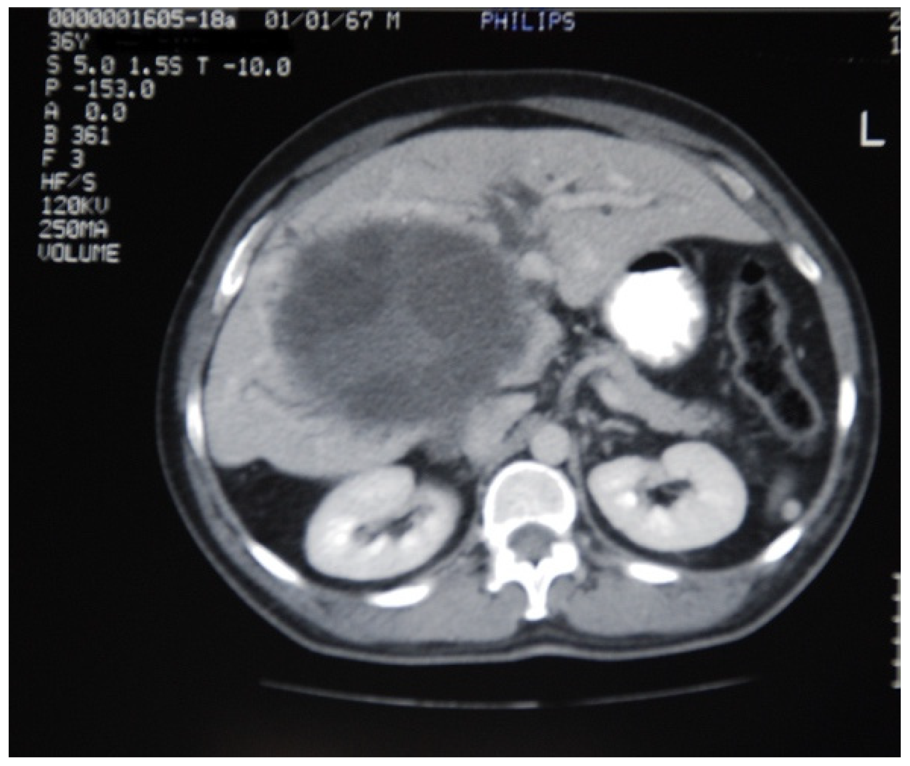 Intraperitoneal rupture of the hydatid cyst: Four case reports and  literature review