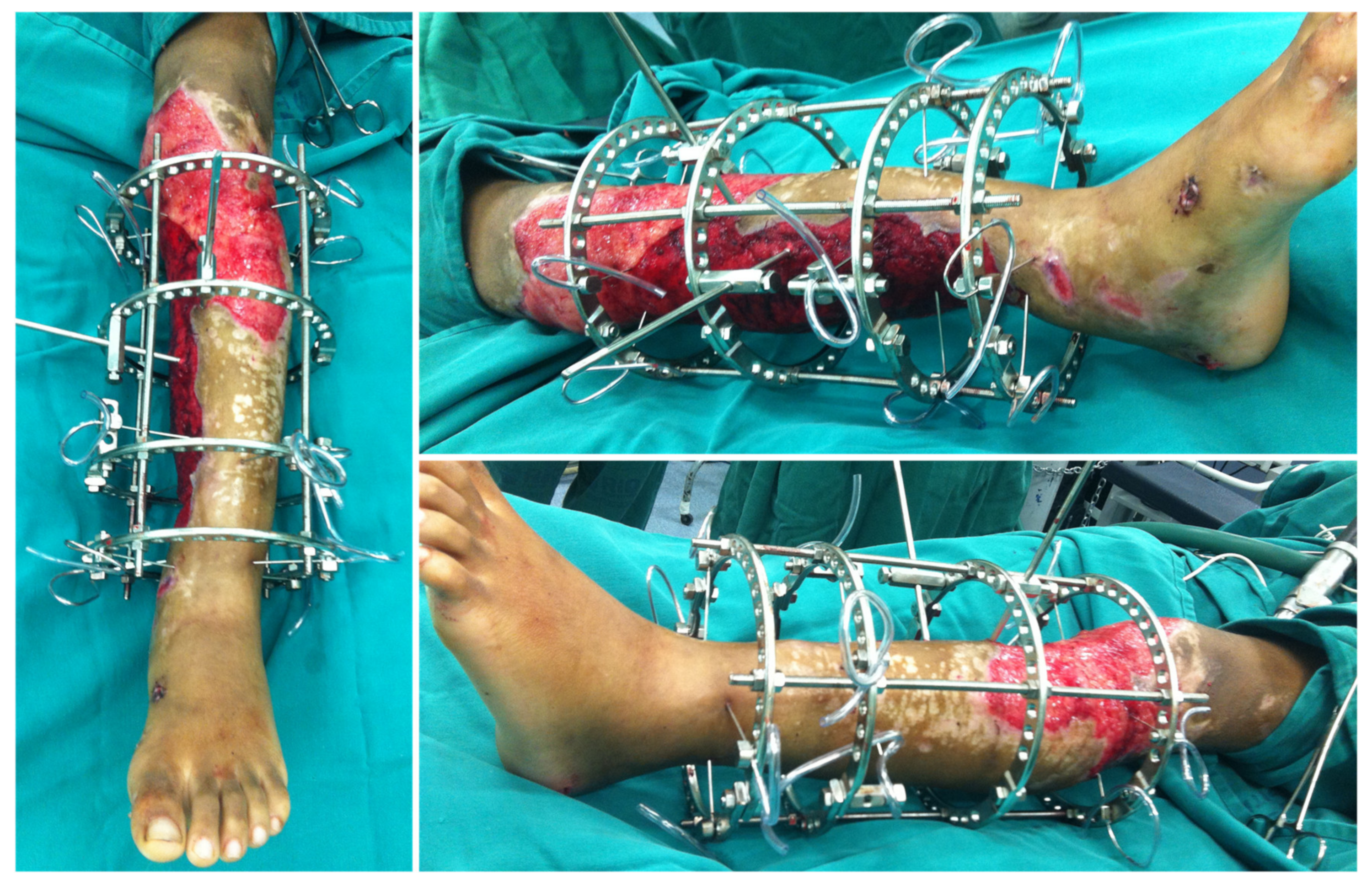 Medicina | Free Full-Text | Limb Salvage after Lower-Leg Fracture and  Popliteal Artery Transection—The Role of Vessel-First Strategy and Bone  Fixation Using the Ilizarov External Fixator Device: A Case Report | HTML