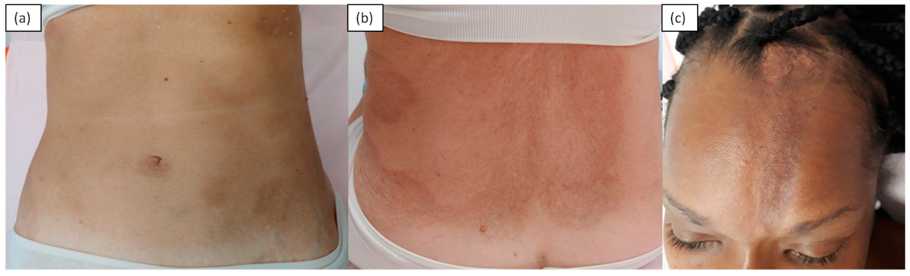 Confluent erythematous papules merging on the lower abdominal region
