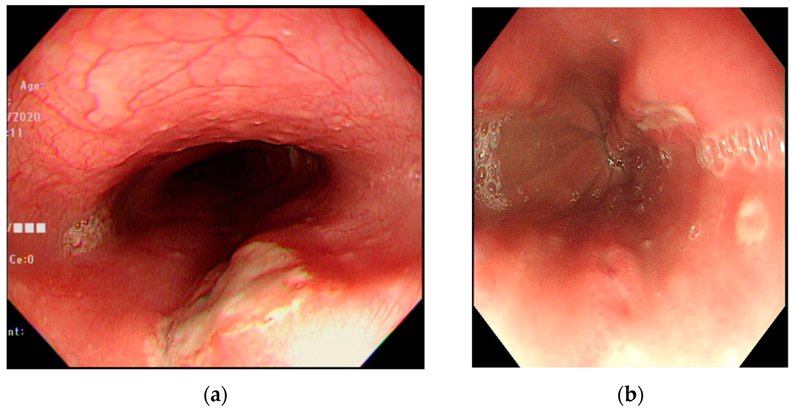 esophageal ulcer