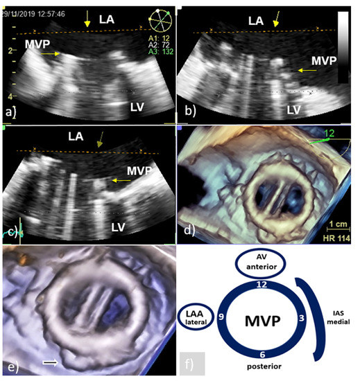 Medicina | Free Full-Text | Three-Dimensional Transesophageal  Echocardiography in the Diagnosis and Treatment of Mitral Prosthetic Valve  Endocarditis&mdash;A Narrative Review
