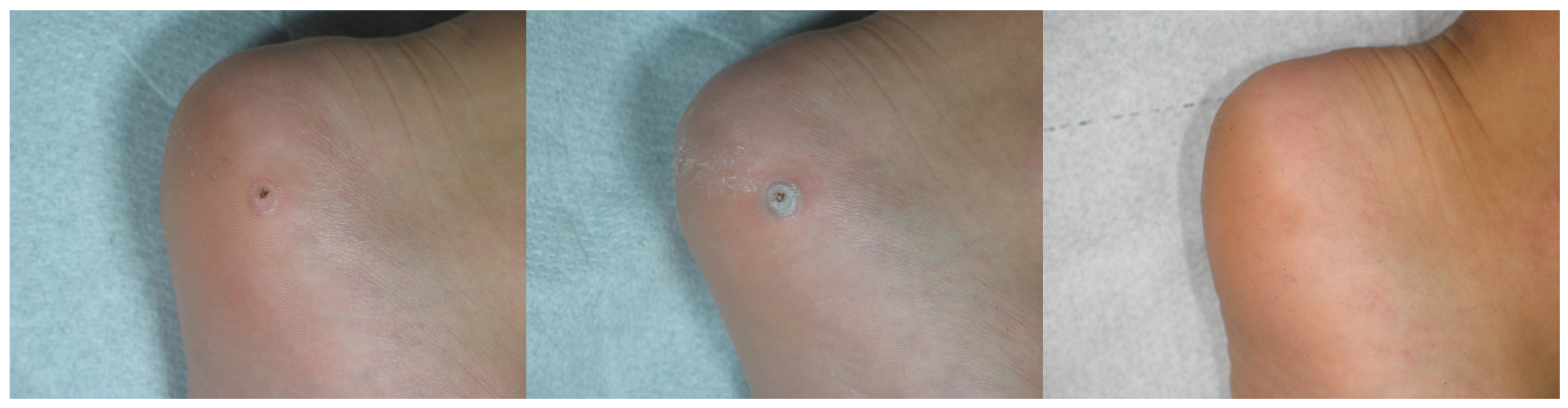 Medicina | Free Full-Text | Sequential Use of CO2 Laser Prior to Nd:YAG and  Dye Laser in the Management of Non-Facial Warts: A Retrospective Study