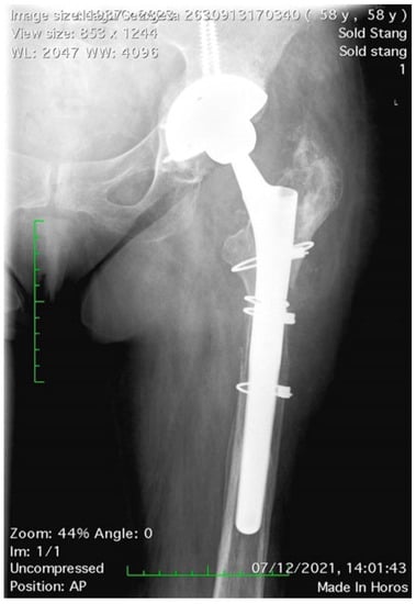 Total Hip Arthroplasty Patients Under 65 Have Low Revision Rates