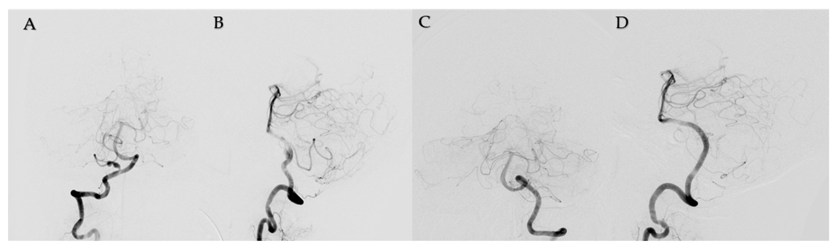 pica aneurysm