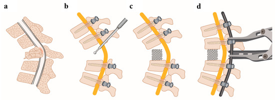 Medicina | Free Full-Text | Outcome after Posterior Vertebral 