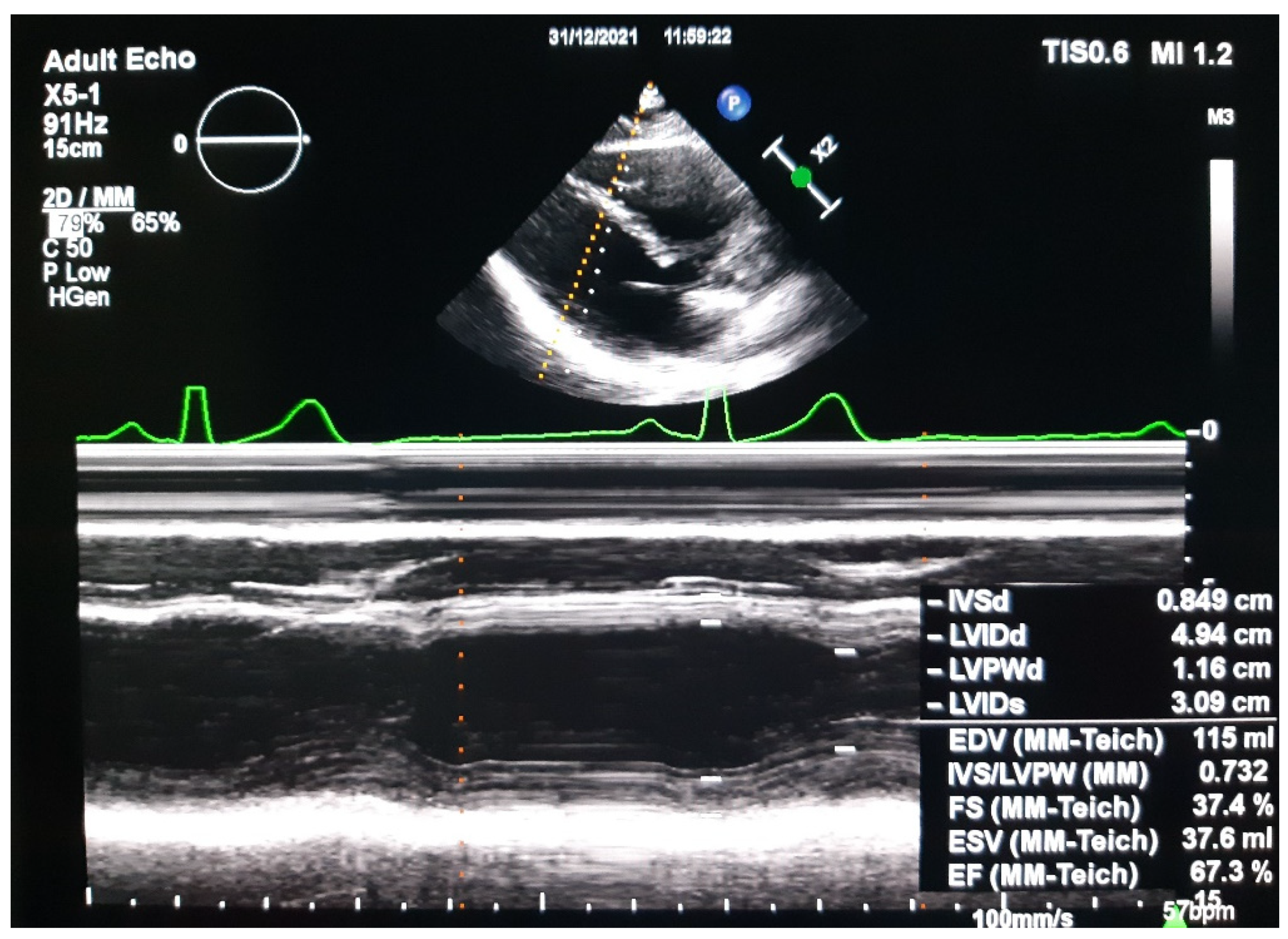 Medicina | Free Full-Text | Pregnancy Complications Lead to Subclinical  Maternal Heart Dysfunction&mdash;The Importance and Benefits of Follow-Up  Using Speckle Tracking Echocardiography