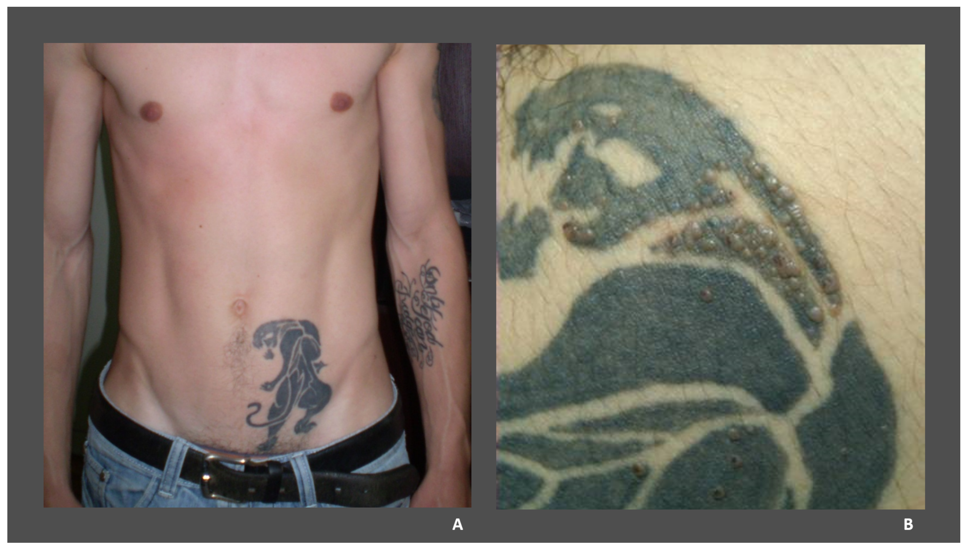 Laser Tattoo Removal  New Pico FracTAT  Skintellect
