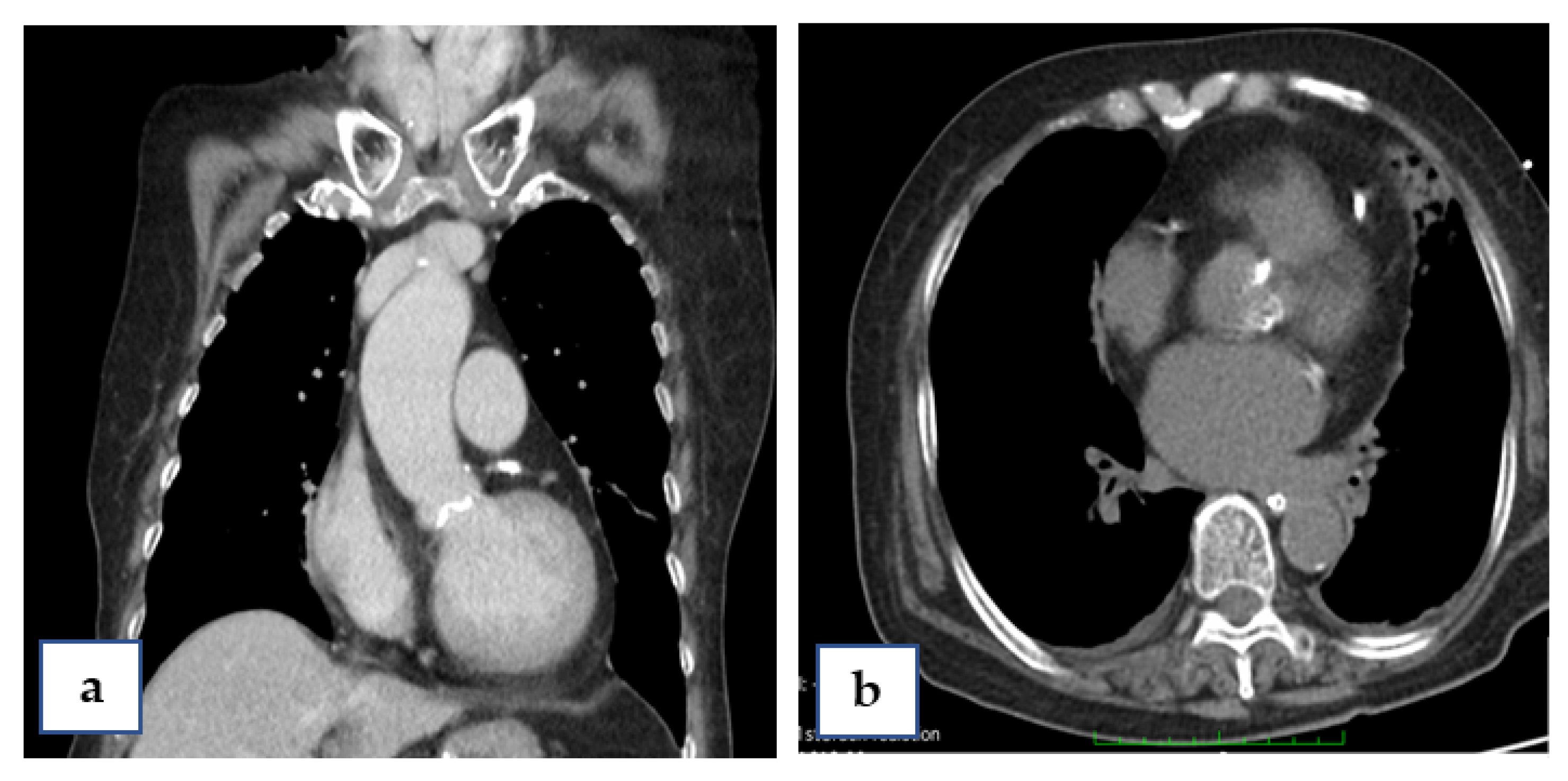 Successful Urgent TAVI for Critical Aortic Valve Stenosis after ECMO ...