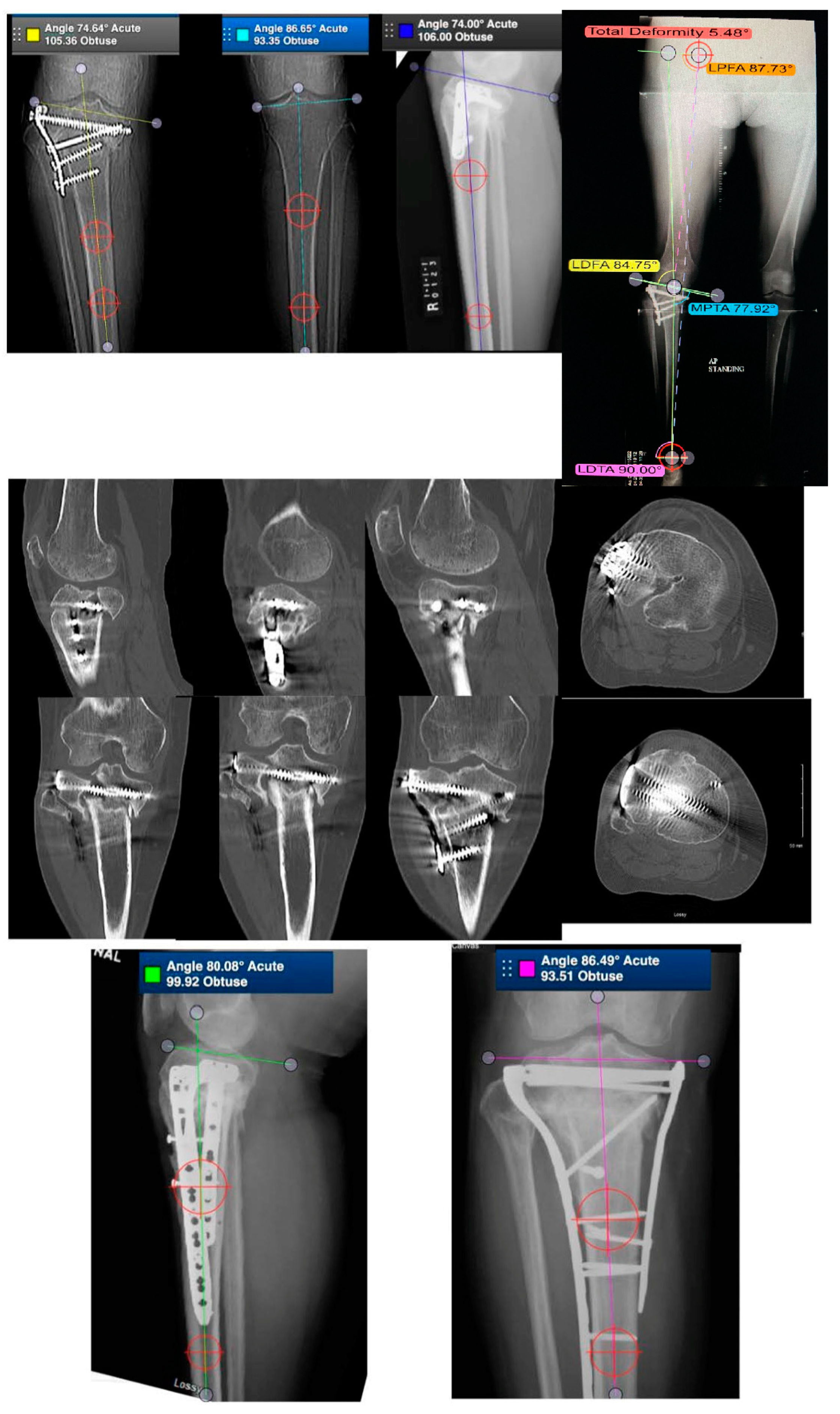 Comparative study between intramedullary interlocking nailing and minimally  invasive percutaneous plate osteosynthesis for dista