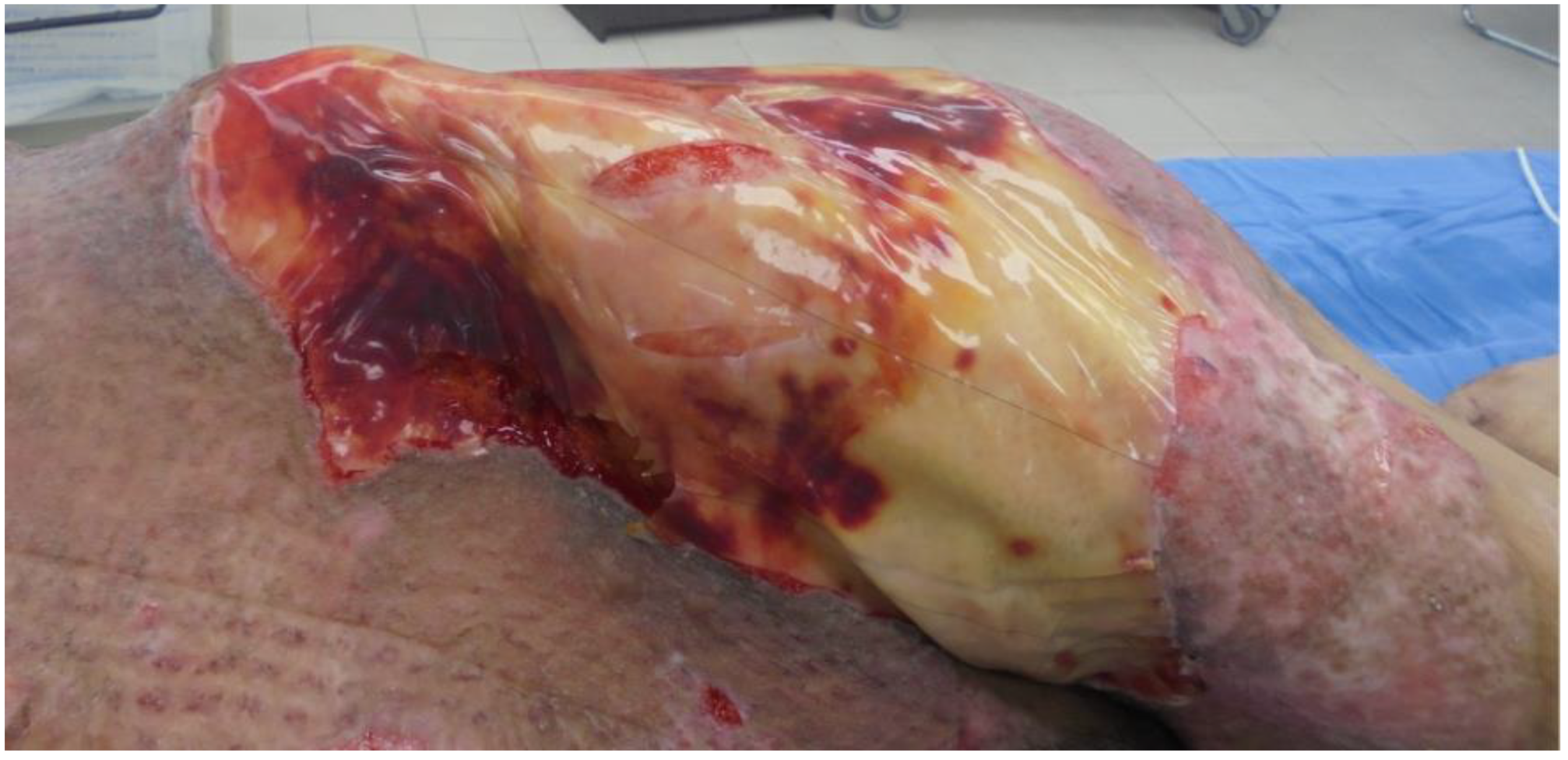 Medicina | Free Full-Text | Review of History of Basic Principles of Burn  Wound Management