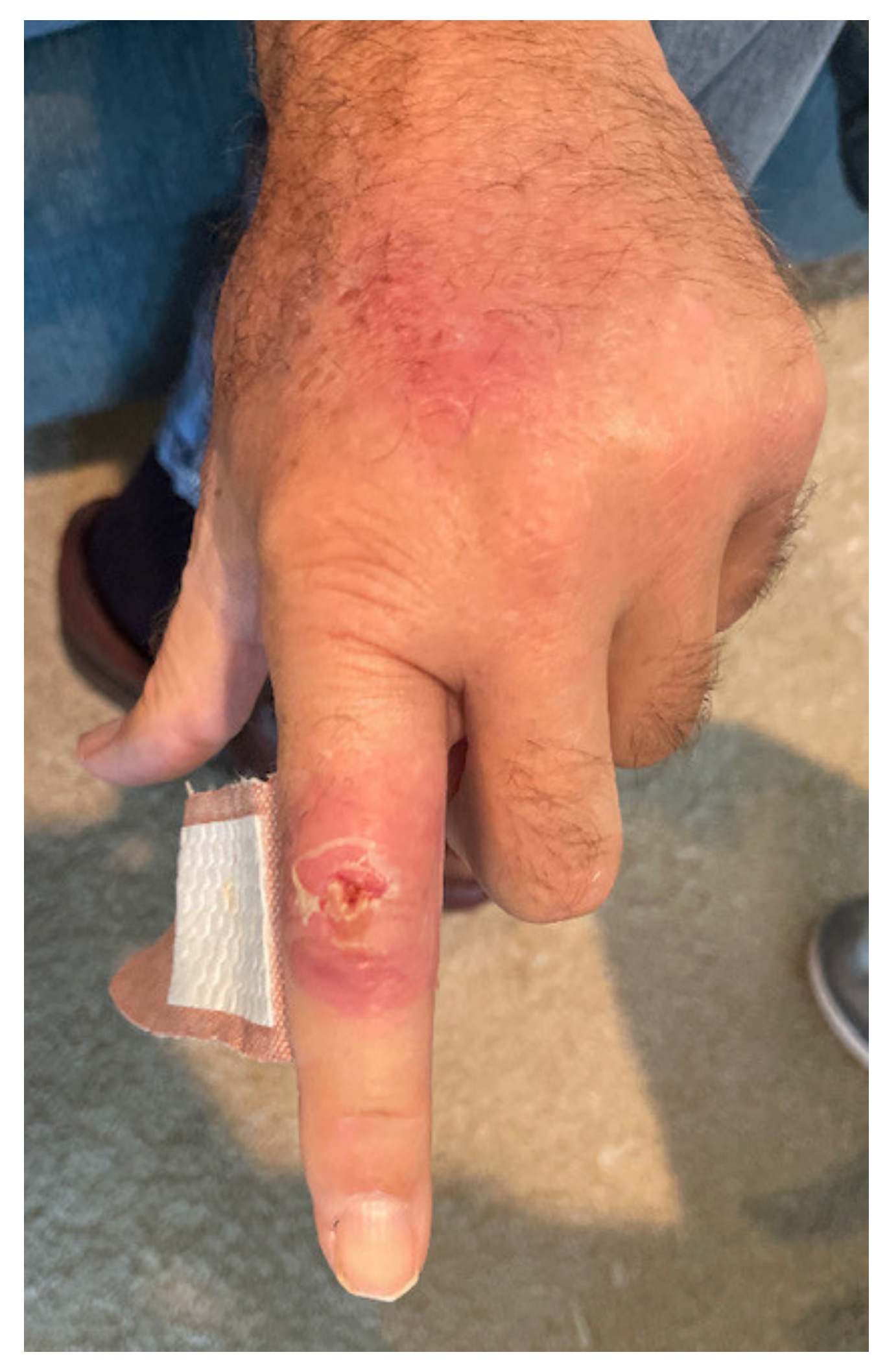Medicina | Free Full-Text | Primary Lymphocutaneous Nocardia brasiliensis  in an Immunocompetent Host: Case Report and Literature Review | HTML