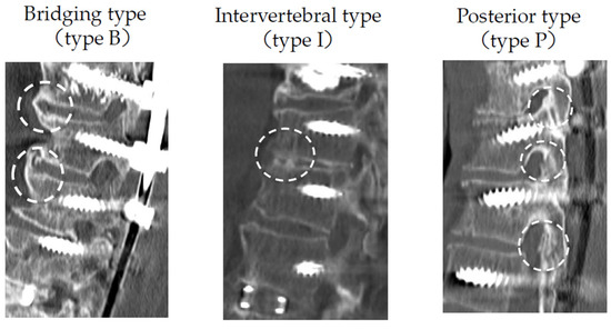 Posterior Thoracic Fusion  Advanced Orthopaedics & Sports