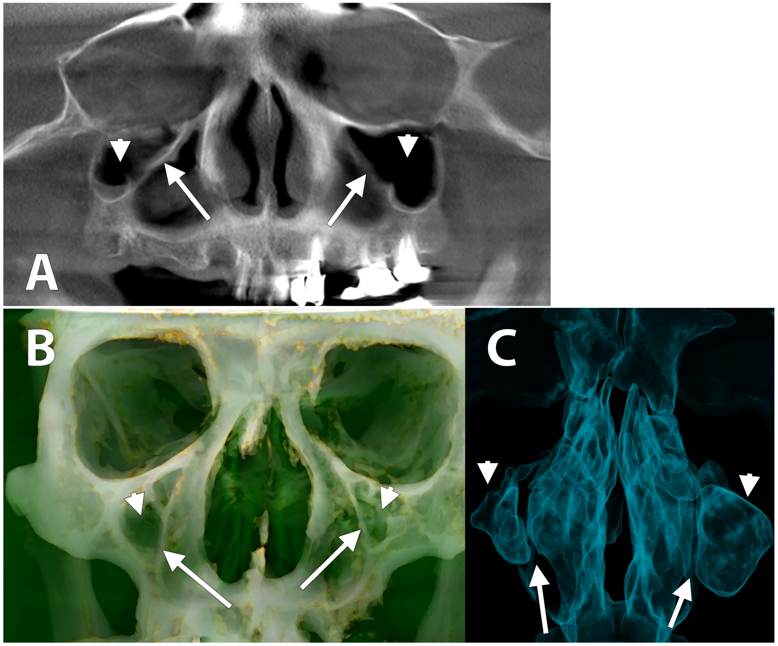 maxillary sinus skull