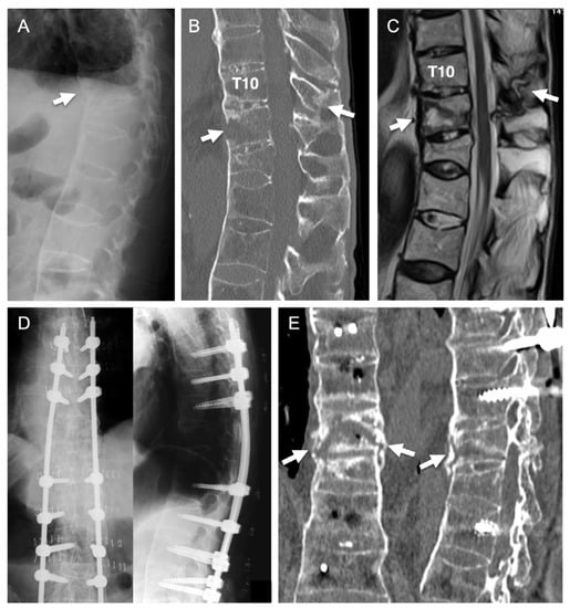 Medicina Free Full Text Reinforcement of Percutaneous Pedicle