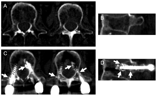 Medicina Free Full Text Reinforcement of Percutaneous Pedicle